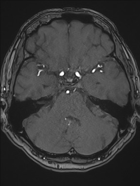 Cerebral arteriovenous malformation (Radiopaedia 84015-99245 Axial TOF 88).jpg