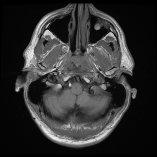 File:Cerebral arteriovenous malformation (Spetzler-Martin grade 2) (Radiopaedia 41262-44092 Axial T1 1).png