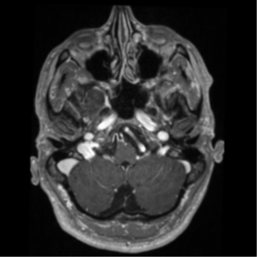 Cerebral arteriovenous malformation - huge (Radiopaedia 35734-37272 Axial T1 C+ 12).png
