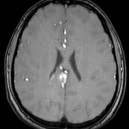 Cerebral arteriovenous malformation at posterior body of corpus callosum (Radiopaedia 74111-84925 Axial MRA 140).jpg
