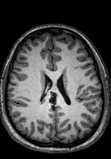 Cerebral arteriovenous malformation at posterior body of corpus callosum (Radiopaedia 74111-84925 Axial T1 105).jpg