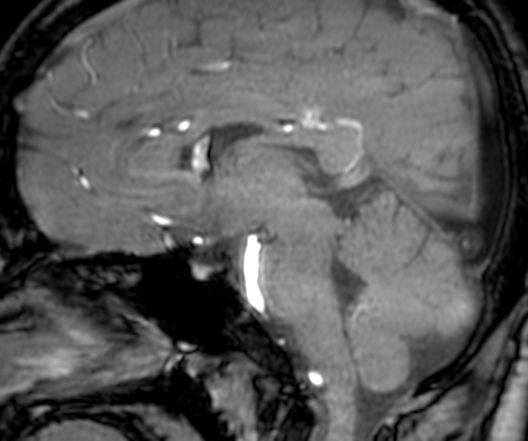 File:Cerebral arteriovenous malformation at posterior body of corpus callosum (Radiopaedia 74111-84925 J 188).jpg
