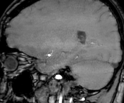 File:Cerebral arteriovenous malformation at posterior body of corpus callosum (Radiopaedia 74111-84925 J 266).jpg