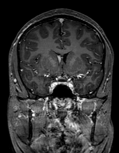 Cerebral arteriovenous malformation at posterior body of corpus callosum (Radiopaedia 74111-84925 K 141).jpg