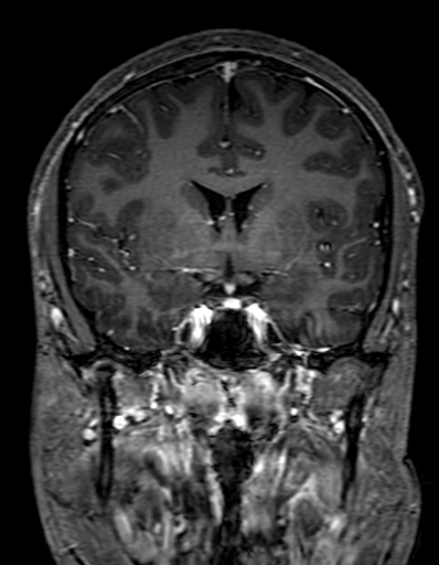 Cerebral arteriovenous malformation at posterior body of corpus callosum (Radiopaedia 74111-84925 K 156).jpg