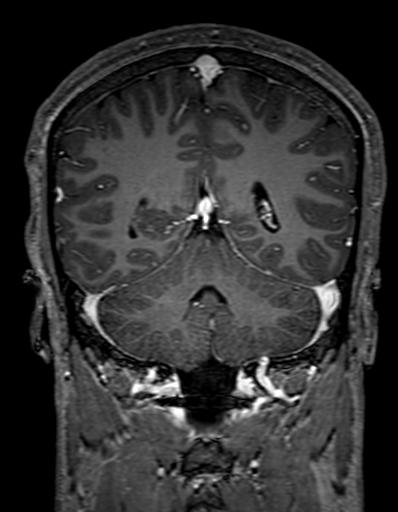 Cerebral arteriovenous malformation at posterior body of corpus callosum (Radiopaedia 74111-84925 K 258).jpg