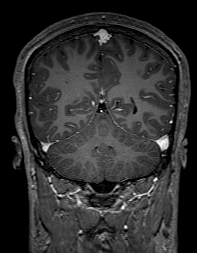 Cerebral arteriovenous malformation at posterior body of corpus callosum (Radiopaedia 74111-84925 K 268).jpg