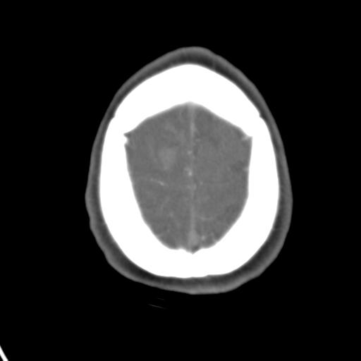 Cerebral arteriovenous malformation with hemorrhage (Radiopaedia 28773-29073 A 8).jpg