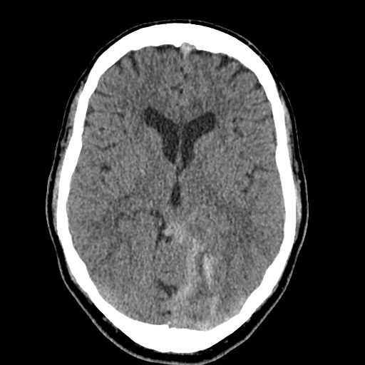 Cerebral arteriovenous malformation with lobar hemorrhage (Radiopaedia 35598-37117 Axial non-contrast 24).jpg