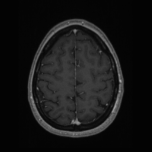 Cerebral cavernoma and development venous anomaly (Radiopaedia 37603-39482 Axial T1 C+ 60).png