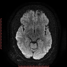 File:Cerebral cavernous malformation (Radiopaedia 26177-26306 Axial DWI 10).jpg