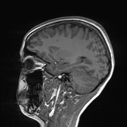 File:Cerebral cavernous venous malformation (Radiopaedia 70008-80021 Sagittal T1 25).jpg