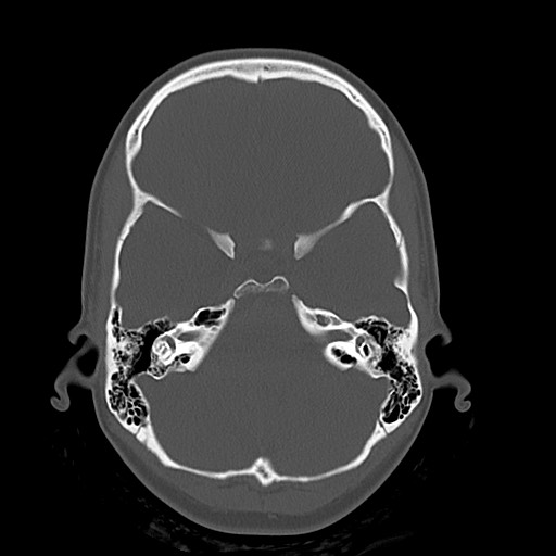 Cerebral cavernous venous malformation (Radiopaedia 70008-80022 Axial bone window 11).jpg