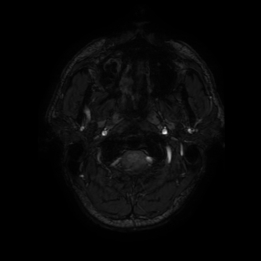 Cerebral cavernous venous malformation (Zabramski type II) (Radiopaedia 85511-101198 Axial SWI 6).jpg
