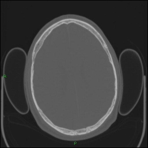 Cerebral contusions (Radiopaedia 33868-35039 Axial bone window 142).jpg