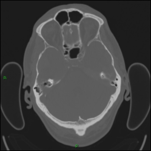Cerebral contusions (Radiopaedia 33868-35039 Axial bone window 58).jpg