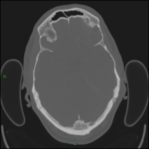 Cerebral contusions (Radiopaedia 33868-35039 Axial bone window 71).jpg