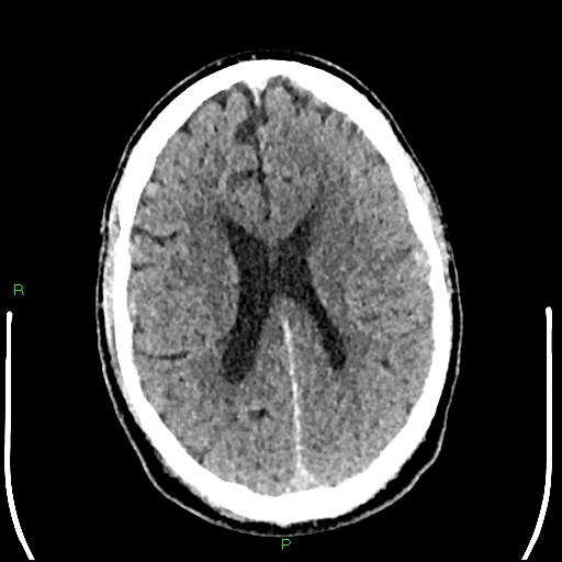 Cerebral contusions (Radiopaedia 33868-35039 Axial non-contrast 134).jpg