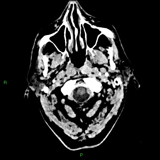 Cerebral contusions (Radiopaedia 33868-35039 Axial non-contrast 2).jpg