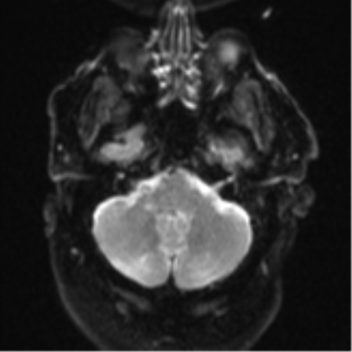File:Cerebral embolic infarcts (embolic shower) (Radiopaedia 57395-64342 Axial DWI 8).png