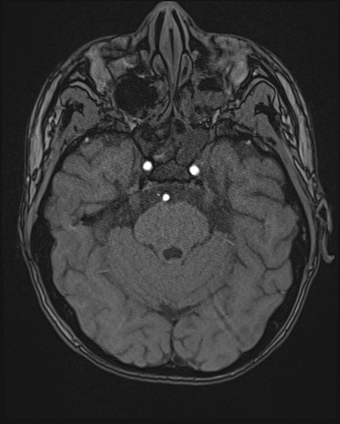 Cerebral embolic infarcts (embolic shower) (Radiopaedia 72391-82921 Axial MRA 39).jpg