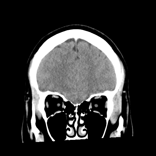 Cerebral hemorrhage secondary to arteriovenous malformation (Radiopaedia 33497-34561 C 16).png
