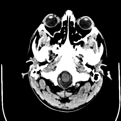 File:Cerebral hemorrhagic contusions- temporal evolution (Radiopaedia 40224-42754 Axial non-contrast 1).png