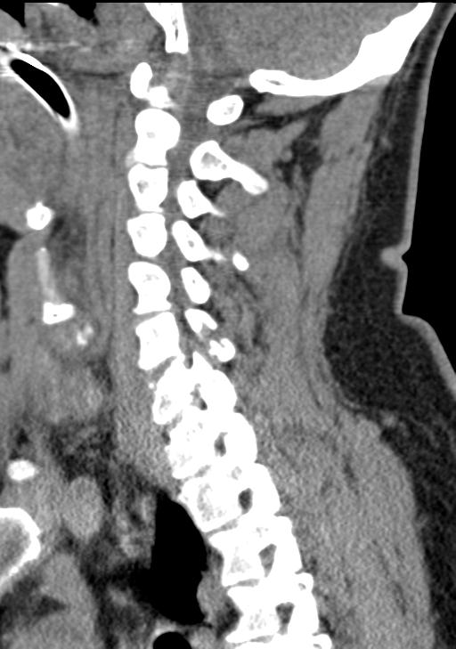 Cerebral hemorrhagic contusions and cervical spine fractures (Radiopaedia 32865-33841 G 66).jpg