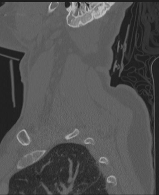 Cerebral hemorrhagic contusions and cervical spine fractures (Radiopaedia 32865-33841 Sagittal bone window 14).jpg