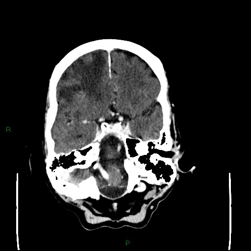 Cerebral metastases - breast primary (Radiopaedia 77653-89857 Axial C+ delayed 34).jpg