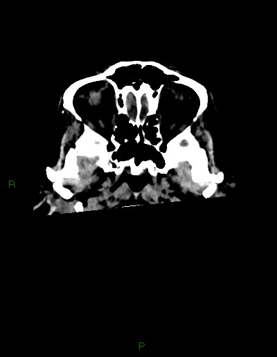 Cerebral metastases - ependymal and parenchymal (Radiopaedia 79877-93131 Axial non-contrast 1).jpg