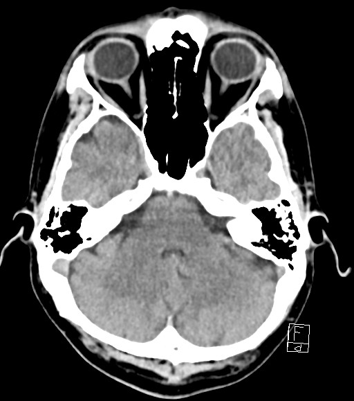 Cerebral metastases - testicular choriocarcinoma (Radiopaedia 84486-99855 Axial non-contrast 41).jpg