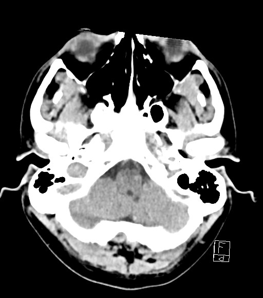 Cerebral metastases - testicular choriocarcinoma (Radiopaedia 84486-99855 Axial non-contrast 46).jpg