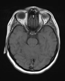 File:Cerebral metastases mimicking abscesses (Radiopaedia 45841-50131 Axial T1 11).png