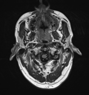 File:Cerebral metastasis - melanoma (Radiopaedia 54718-60954 Axial FLAIR 1).png