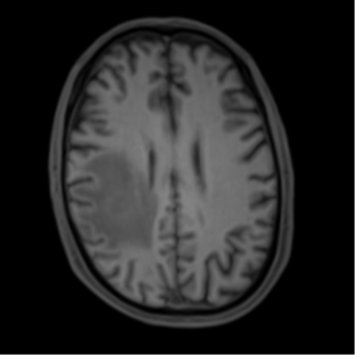 Cerebral metastasis - melanoma (Radiopaedia 54718-60954 Axial T1 35).png