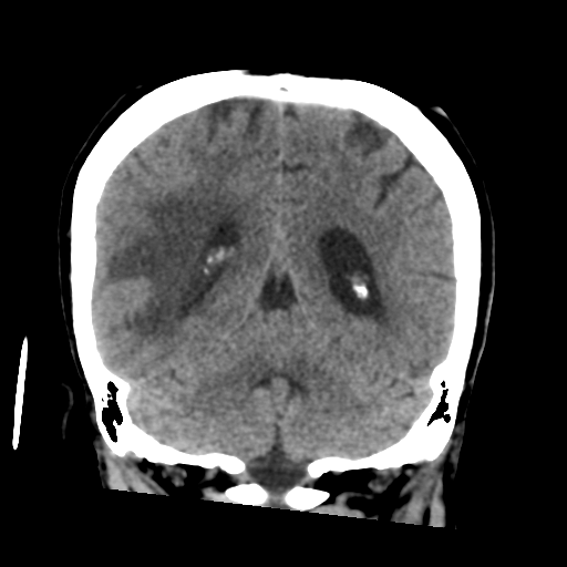 Cerebral metastasis to basal ganglia (Radiopaedia 81568-95412 Coronal non-contrast 47).png