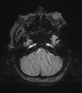 Cerebral metastasis to basal ganglia (Radiopaedia 81568-95413 Axial SWI magnitude 15).png