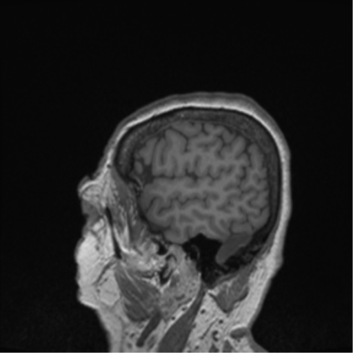 Cerebral metastasis to basal ganglia (Radiopaedia 81568-95413 Sagittal T1 8).png