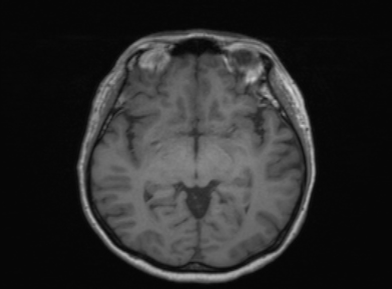 Cerebral ring enhancing lesions - cerebral metastases (Radiopaedia 44922-48817 Axial T1 243).jpg