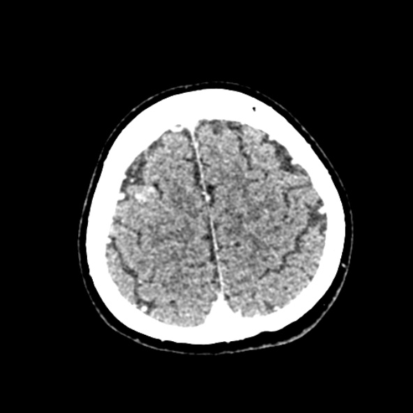 Cerebral ring enhancing lesions - cerebral metastases (Radiopaedia 44922-48818 B 236).jpg