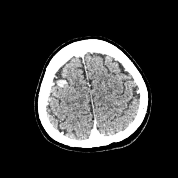 Cerebral ring enhancing lesions - cerebral metastases (Radiopaedia 44922-48818 B 238).jpg