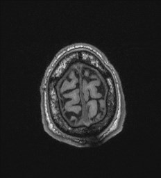 Cerebral toxoplasmosis (Radiopaedia 43956-47461 Axial T1 73).jpg
