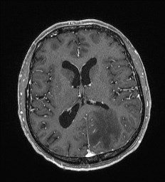 Cerebral toxoplasmosis (Radiopaedia 43956-47461 Axial T1 C+ 41).jpg