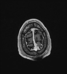 Cerebral toxoplasmosis (Radiopaedia 43956-47461 Axial T1 C+ 72).jpg