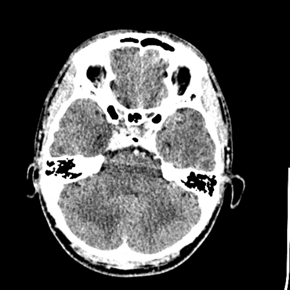 Cerebral toxoplasmosis (Radiopaedia 53993-60131 Axial C+ delayed 21).jpg