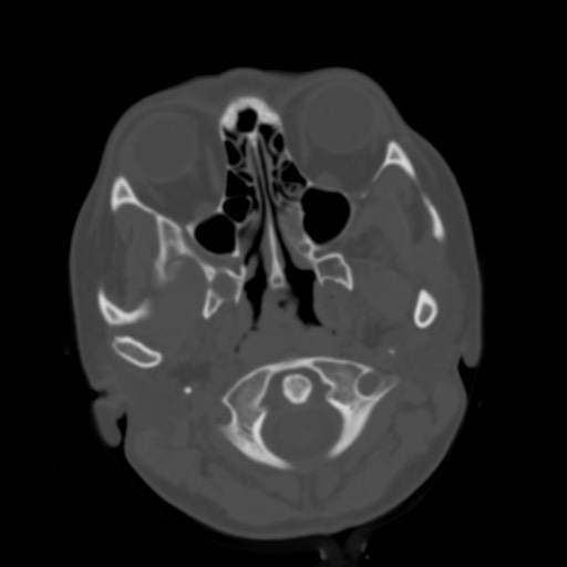 Cerebral tuberculosis with dural sinus invasion (Radiopaedia 60353-68018 Axial bone window 1).jpg