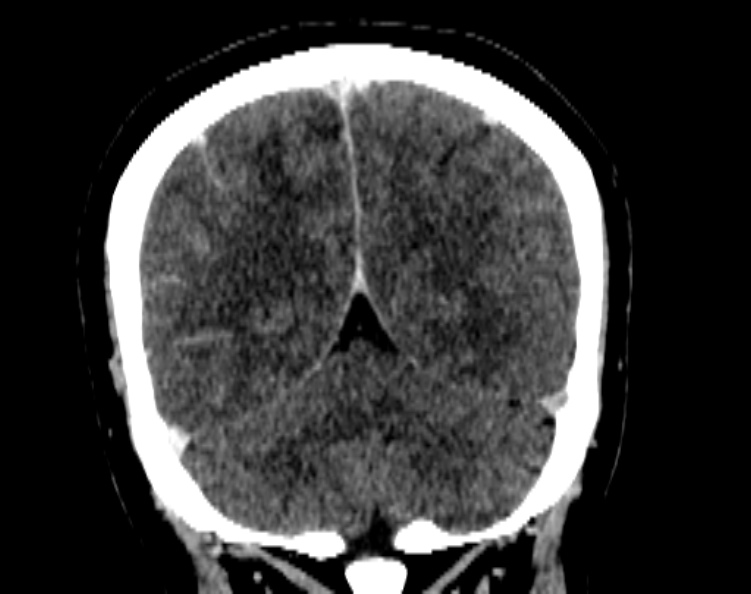 Cerebral venous hemorrhagic infarct from venous sinus thrombosis (Radiopaedia 55433-61883 Coronal C+ delayed 46).jpg