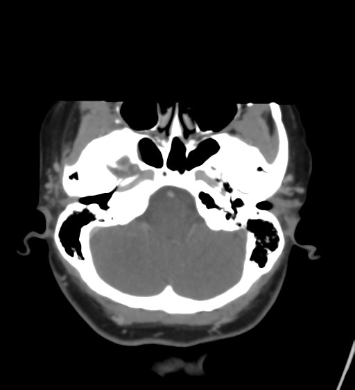 File:Cerebral venous infarction due to transverse sinus thrombosis (Radiopaedia 34688-36120 Axial CT venogram 12).png