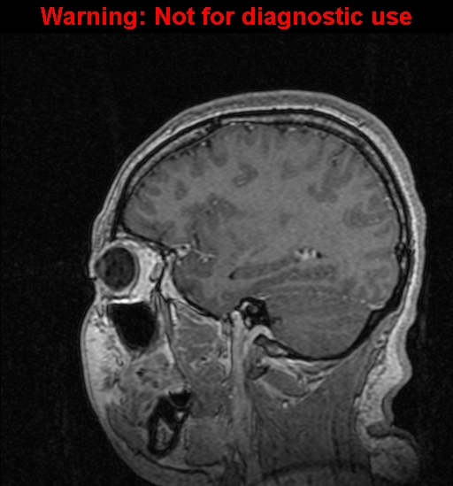 Cerebral venous thrombosis (Radiopaedia 37224-39208 Sagittal T1 C+ 108).jpg